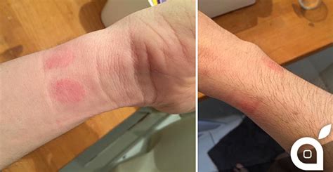 watch rash allergic reaction